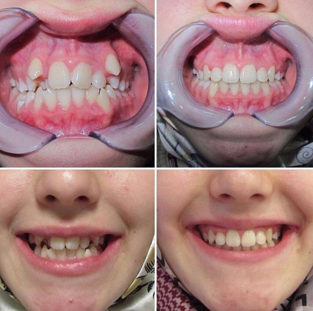 Case Study : Seamless Dental Implant Experience in Turkey